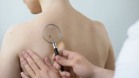 Physician examining birthmark with magnifying glass, diagnosis of skin cancer