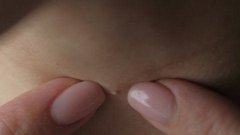 Close up photo of acne prone skin, young woman squeezing her pimple, Removing pimple from neck. Acne pus. squeezing pimple macro