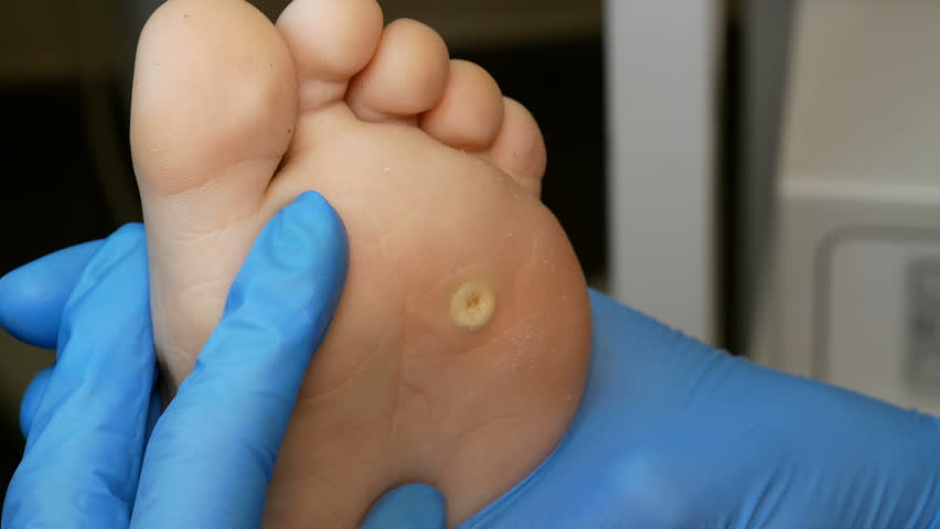 warts on foot liquid nitrogen tratament antiparazitar adulti