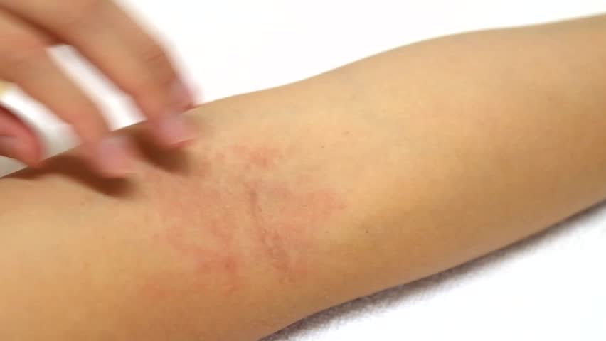 Women's hands are scratching allergy to red rash on white background | Shutterstock HD Video #1010689892