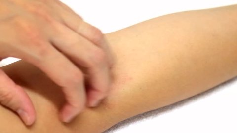 Women's hands are scratching allergy to red rash on white background