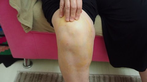 swollen right knee cap and old woman massaging the aching knee,4k