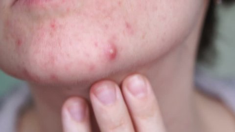Closeup woman face with big ugly pimple. Acne teenager, skin problem person 4k