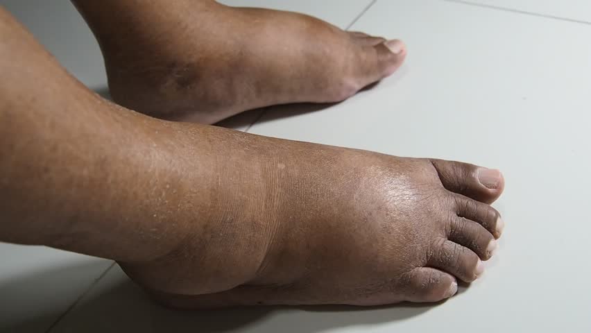 The feet of people with diabetes, dull and swollen. Due to the toxicity of diabetes placed on a white background. Fingers hit the back of the diabetic foot. To test foot swelling. | Shutterstock HD Video #1011180701