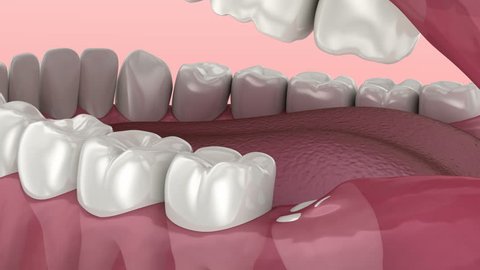 Wisdom tooth problem. Medically accurate tooth 3D animation 
