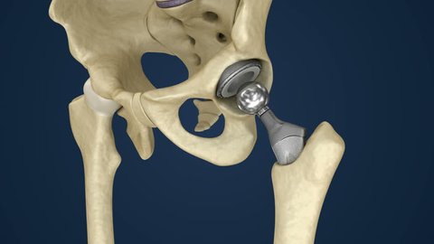 Hip Replacement Implant Installed Pelvis Bone Stock Footage Video (100% 