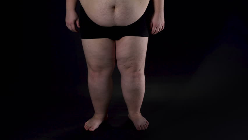 Ноги у толстых людей. Ожирение. Мужчины с толстыми ногами.