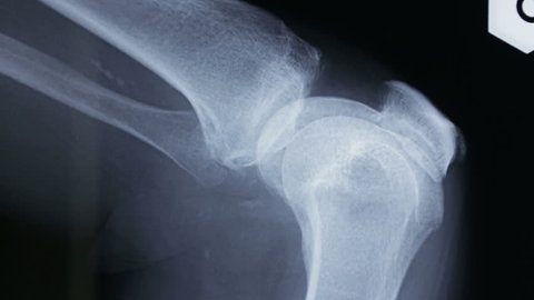 Lateral tracking on X-ray plate of the femur and bones of the human knee