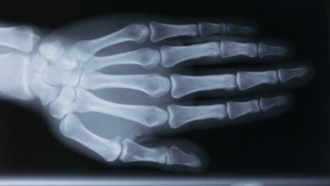 Tracking on X-ray plate of the bones of the human hand