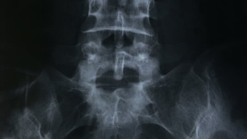 Frontal tracking on X-ray plate of the bones of the vertebral column and of the human pelvis