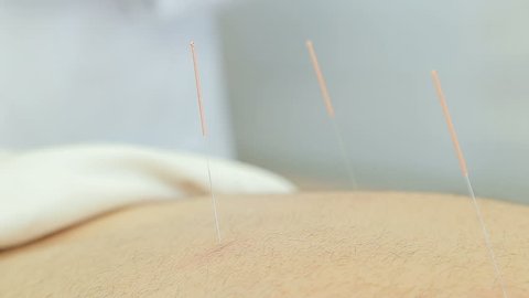 Acupuncture medical procedure