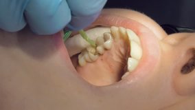 Woman at the dentist clinic office gets dental medical examination and treatment. Close up shot. Vertical format video.