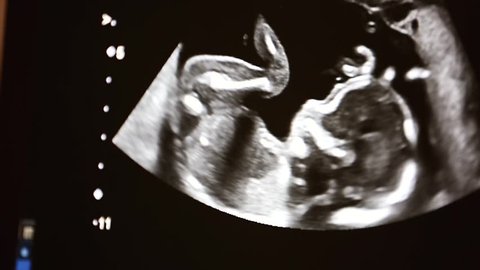 Ultrasound machine screen with unborn baby on it