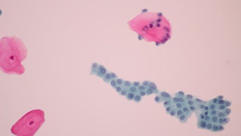 View in microscopic screening of normal human cervix cells in Cytology and pathology department.Pap smear check up.