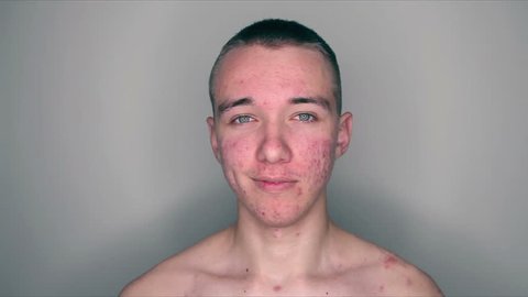 Teenage boy with puberty acne problem