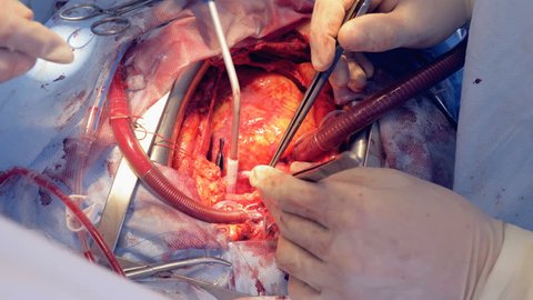 Real heart beats through open chest during surgery. 4K.