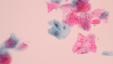 View in microscopic of abnormal human cervical epithelial cells in pap smear slide screening. Cytology and pathology diagnosis.Medical concept. Under microscope, magnification 600X