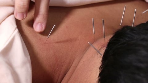 Traditional Chinese Medicine Acupuncture to treat men
