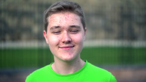 Teenage boy with puberty acne problem. Teenage skin
