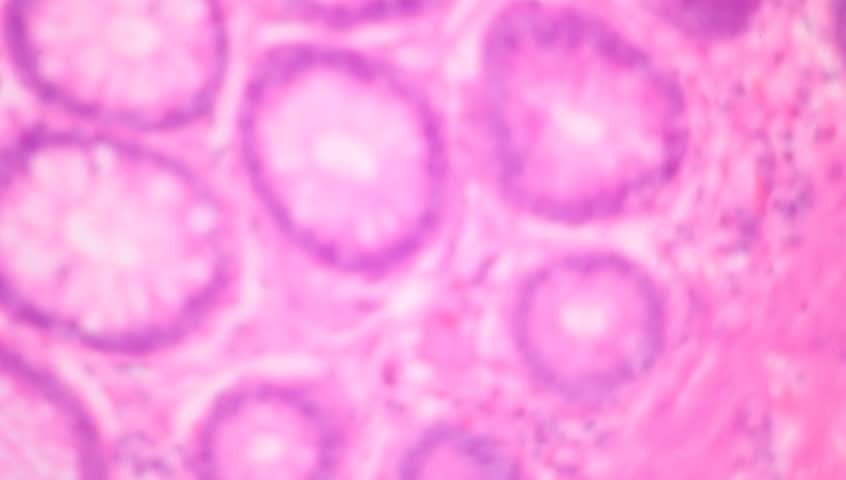 View in microscopic of ductal cell carcinoma, adenonocarcinoma from human breast cancer, tissue section by H and E stain.Pathology diagnosis.Medical concept. Under microscope, magnification 600X Royalty-Free Stock Footage #1012767437