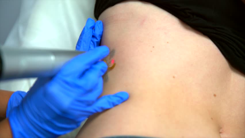 This close-up slow motion video shows a laser tattoo removal procedure being performed on a caucasian woman by a doctor with blue gloves. Royalty-Free Stock Footage #1012937657