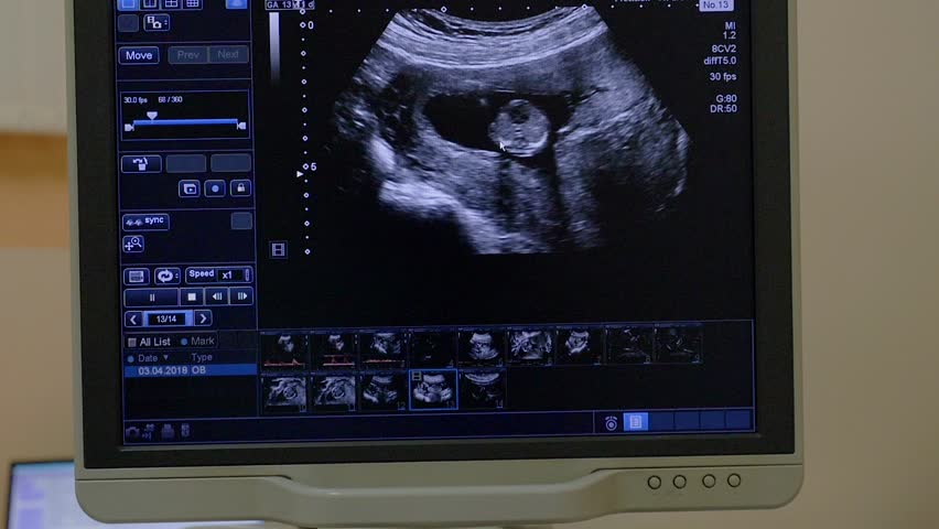 ultrasonographical examination shows tumour in female reproductive system on modern ultrasound machine monitor closeup Royalty-Free Stock Footage #1013112449
