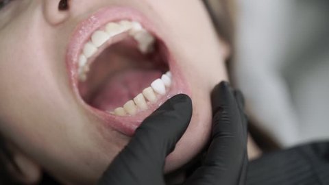 Patient in dental clinic on chair with veneers