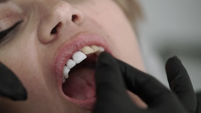 Patient in dental clinic on chair with veneers Royalty-Free Stock Footage #1013336579