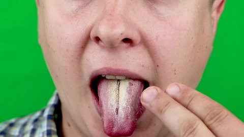 Infection tongue disease candida albicans
