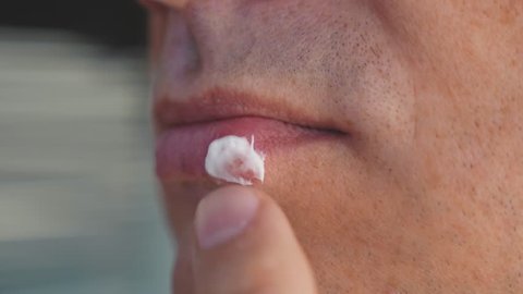 A young man with herpes on his lips.Herpes. Lip treatment. Close up. A man puts a cream on his lips. Viral disease.