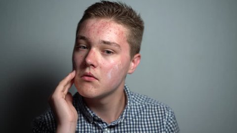 Man putting cream on his irritated face skin. Unhappy teenager taking care of his problematic skin. Conception of skin care
