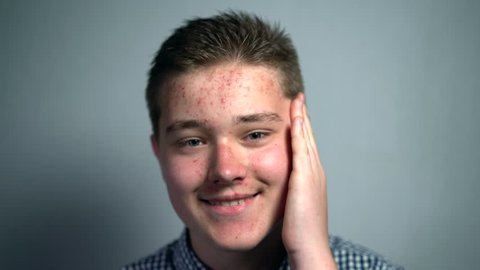 Young teenager boy with puberty acne problems looking at the camera in the studio on the grey background. Guy smiling and touching his allergic face skin