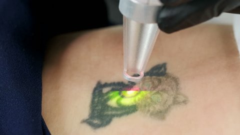 Close-up view of a laser treatment for a woman in clinic. Doctor in gloves. Master using a laser to remove old tattoo. Beautiful young woman on laser tattoo removal treatment