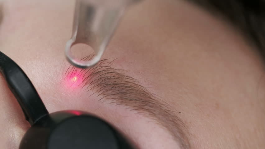 Woman undergoing laser removal of permanent makeup in salon. Eyebrow correction. Closeup female receiving correction of a tattoo on eyebrows procedure Royalty-Free Stock Footage #1013754485