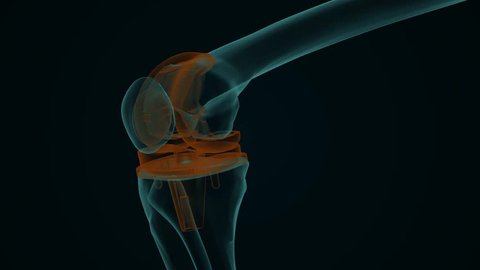 X-ray of a human knee with knee replacement isolated on a black background