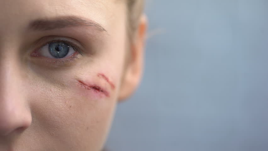 defenseless female scars on her face Stok Videosu (%100 Telifsiz) 101392730...