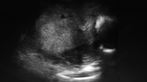 Footage of Ultrasonography on the third trimester pregnancy. (Black and white)