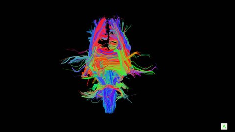 Magnetic Resonance Diffusion Tensor Imaging (MR DTI) with tractography of corticospinal tracts  rotating on 360 degrees