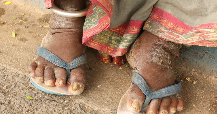 Old women Foot on hospital bed