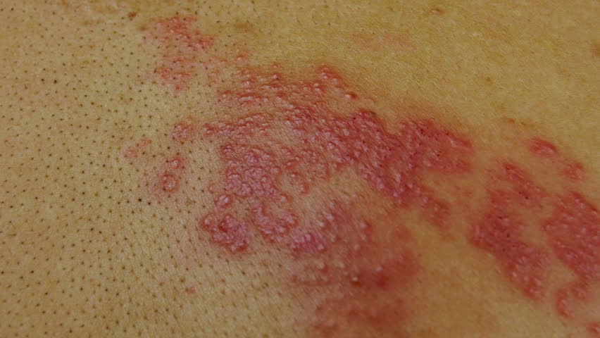 Chicken Pox Symptoms Stock Video Footage - 4k And Hd Video Clips 