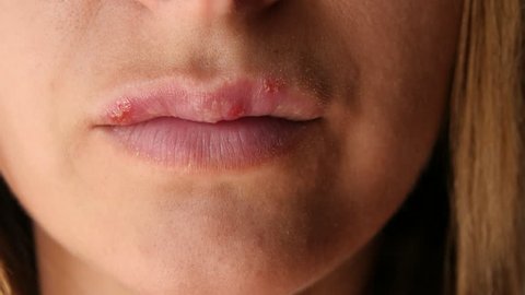 Beautiful young woman with sores from herpes on her lips. The girl is sick of laughing because of the cold on her lips. Grimace of pain.