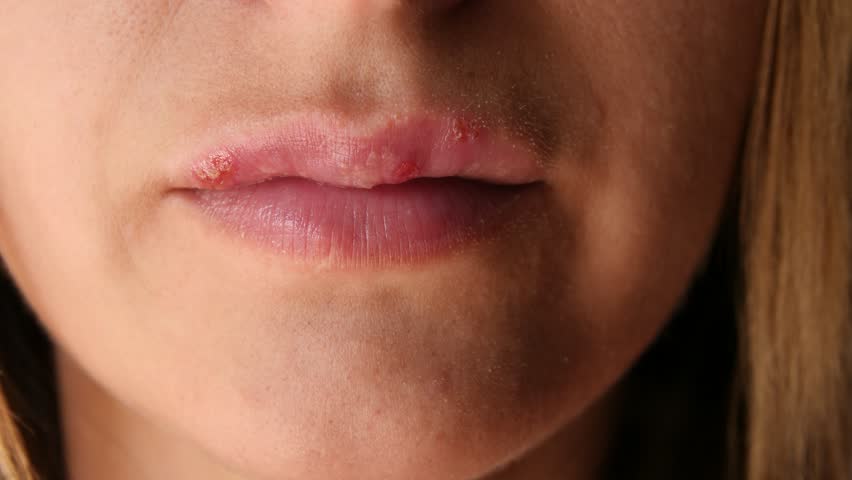 Woman touches the sores from herpes on her lips. Women's lip ulcers herpes closeup. Beautiful lips were covered with cold sores. The girl licks her lips covered with herpes. | Shutterstock HD Video #1014631658