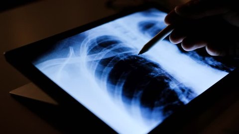 Doctor analyzing cancer chest lungs x-ray tommography medical data on touchscreen computer, work late at night, working with modern digital technology; coronavirus pneumonia test