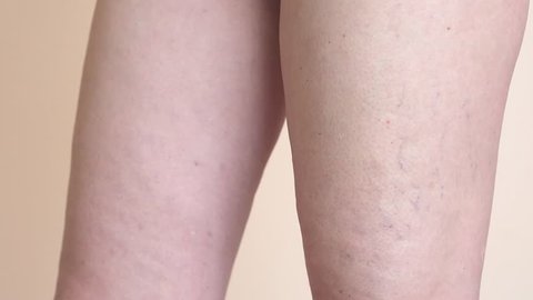 Middle aged woman applying medical gel on varicose veins and capillaries on her leg 