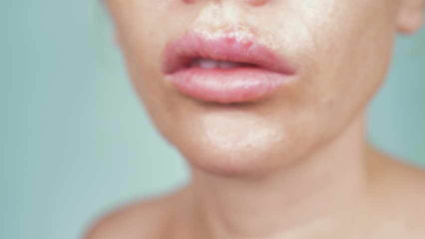 Herpes Pictures Female Lips | Lipstutorial.org