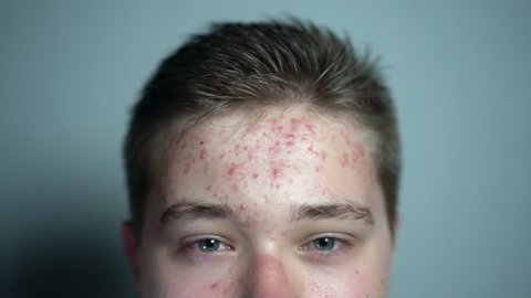Close up of a young happy man with a problem skin looking at the camera. Dermatological problems in a teenager. Young guy in a transitional age.