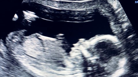 Baby in mother's womb is moving during sonography