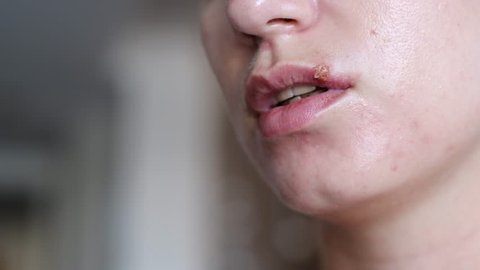 Young woman with problematic skin touching sores from herpes and suffering pain on her chapped lips. Lip treatment concept.