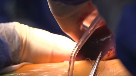 Surgery operation on liver with flesh of a patient and a see-through tube