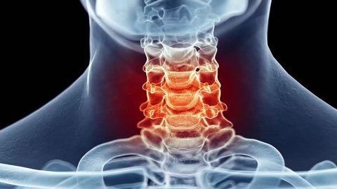 3d rendered medically accurate animation of a painful neck